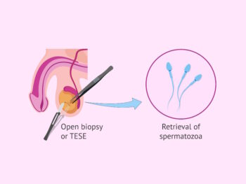 Операция Testicular Sperm Extraction (TESE)