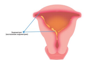Причины тонкого эндометрия