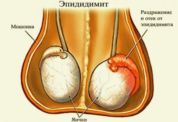 Симптомы и причины эпидидимита