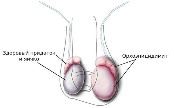 Причины и симптомы орхита