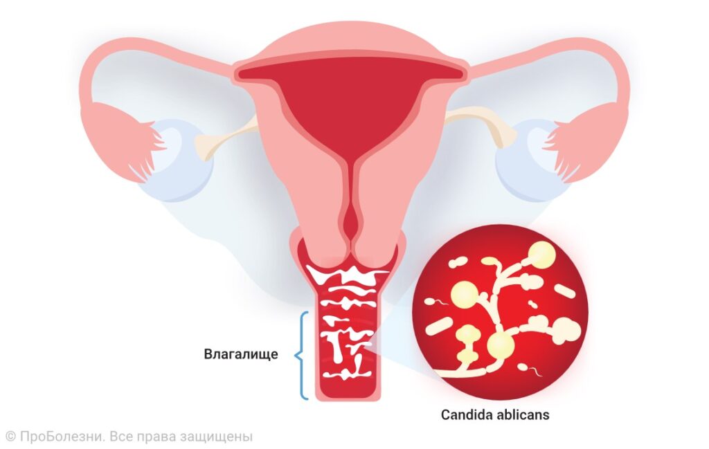 Причины молочницы и ее лечение в Ташкенте