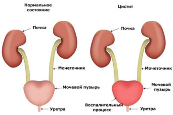 цистит Причины цистита
