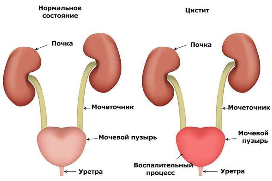 Причины цистита