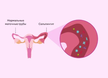 Диагностика сальпингита в Израильском медицинском центре в Ташкенте