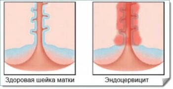 Диагностика эндоцервицита в Ташкенте Диагностика эндоцервицита в Ташкенте