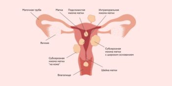 Мониторинг миомы матки во время беременности Мониторинг миомы матки во время беременности