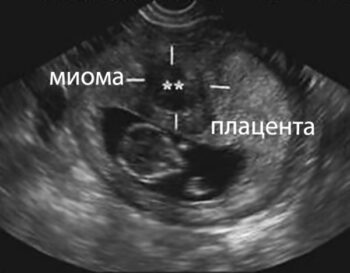 Влияние миомы матки на беременность Влияние миомы матки на беременность