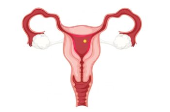 преждевременная недостаточность яичников - лечение и диагностика