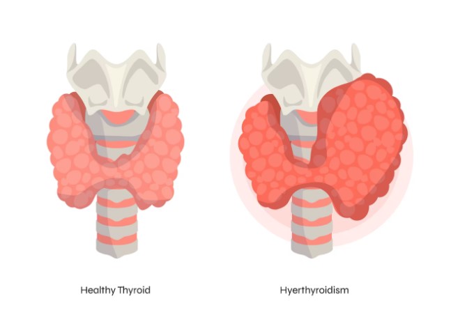 Причины и симптомы заболеваний щитовидной железы