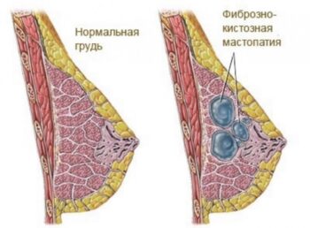 Успокойте свои тревоги: исключите риски и получите эффективное лечение мастопатии в Израильском медицинском центре в Ташкенте