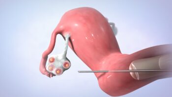 пункция при ЭКО в Израильском медицинском центре в Ташкенте