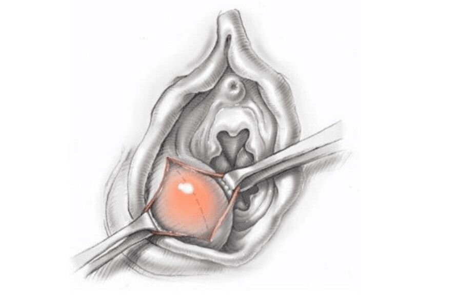 Диагностика образований у входа во влагалище: от безболезненной кисты до острого абсцесса. Точная диагностика и тактика лечения в Израильском медицинском центре в Ташкенте