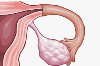 Лечение синдрома гиперстимуляции яичников, возникающего после стимуляции овуляции, в Израильском медицинском центре в Ташкенте